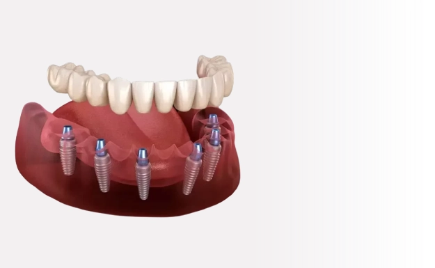 Implantes Dentários